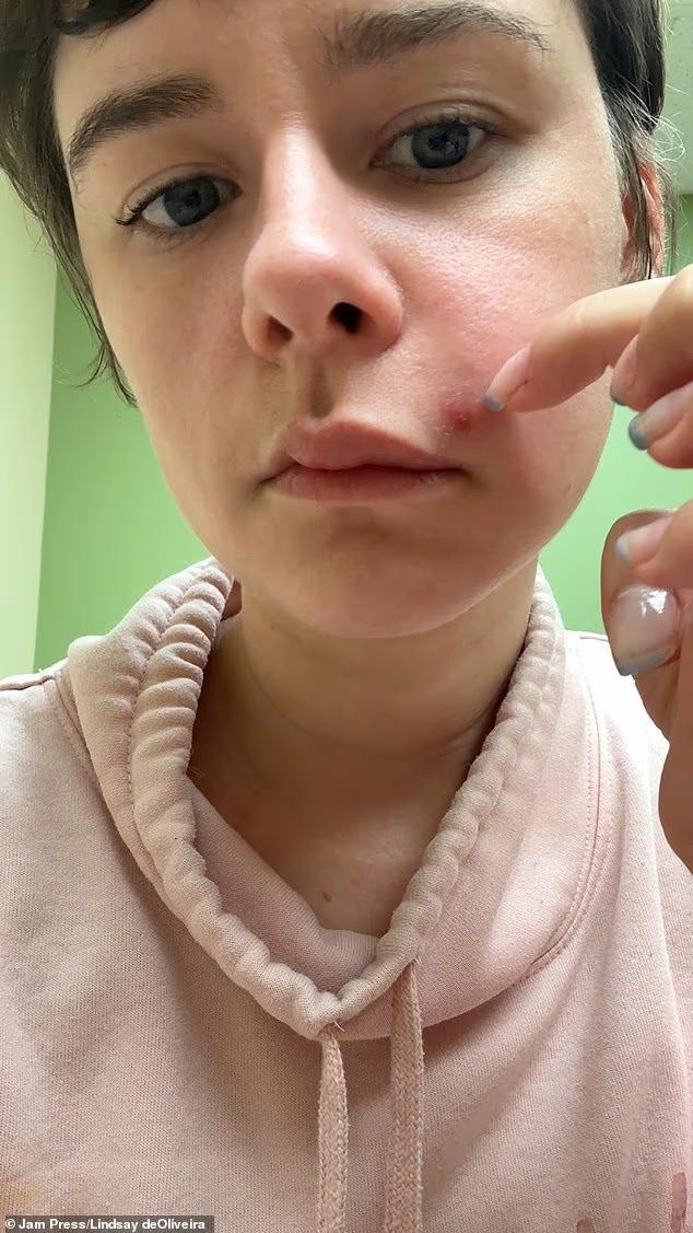 美国一女子挤痘痘致半边脸面瘫
